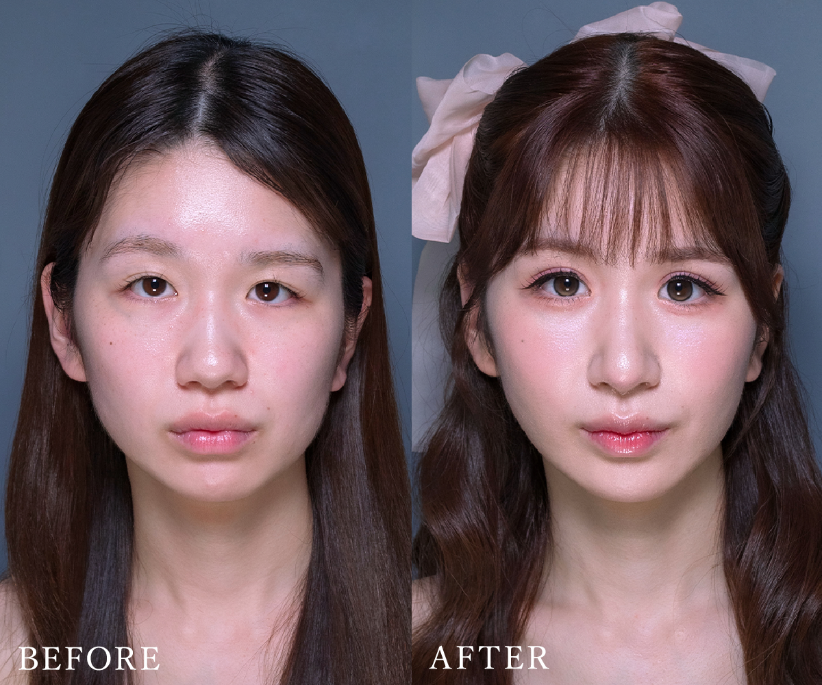 額・こめかみの脂肪注入ビフォーアフター