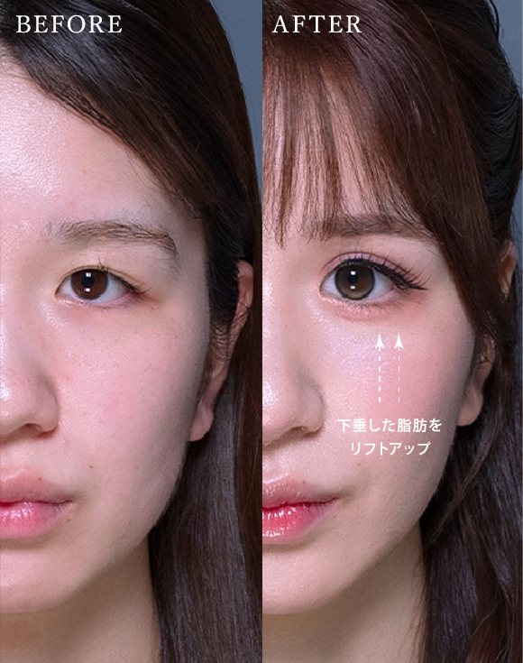 バーティカルリフトビフォーアフター