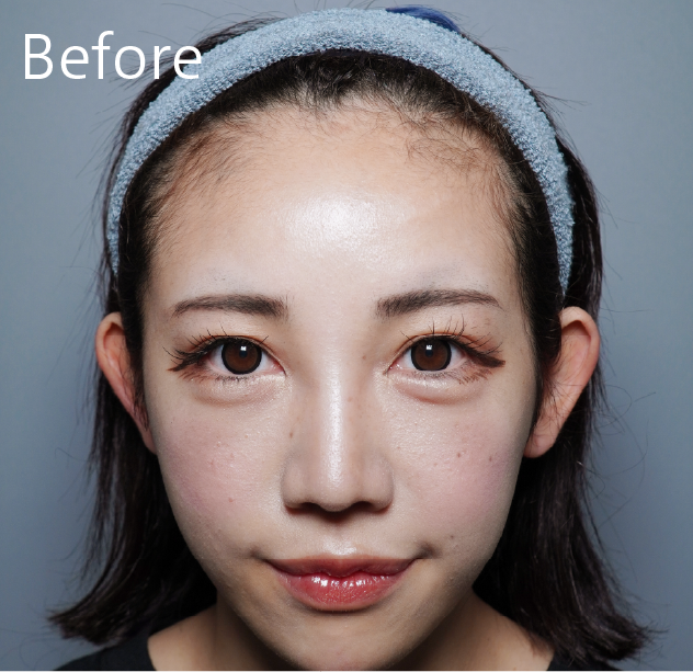 額のヒアルロン酸before