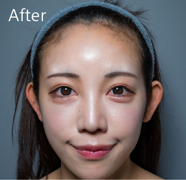 額のヒアルロン酸after
