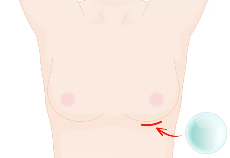 バッグ豊胸乳房下溝からの挿入画像