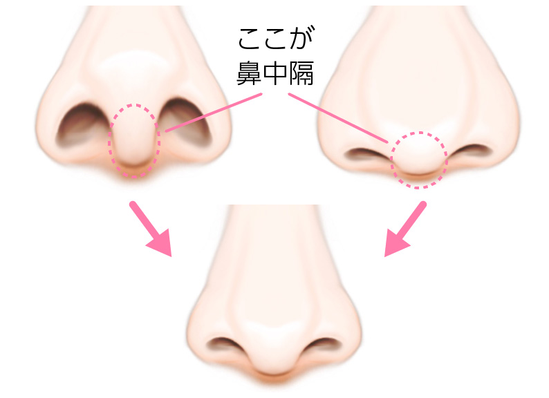 鼻中隔延長施術の変化のイメージ