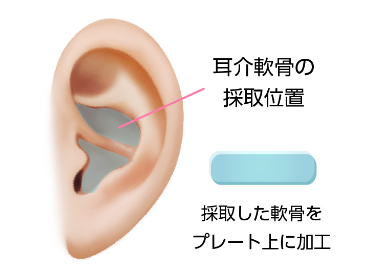 耳介軟骨のイメージ