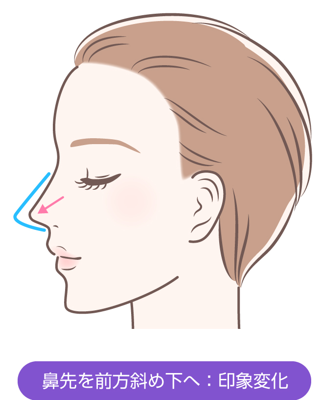 鼻先を前方斜め下へ：印象変化