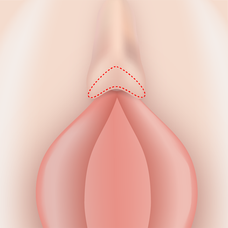 クリトリス包茎切除方法イメージ