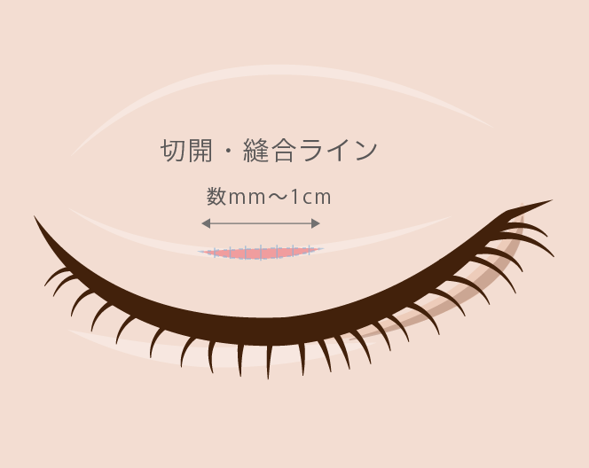 二重整形部分切開法の施術箇所