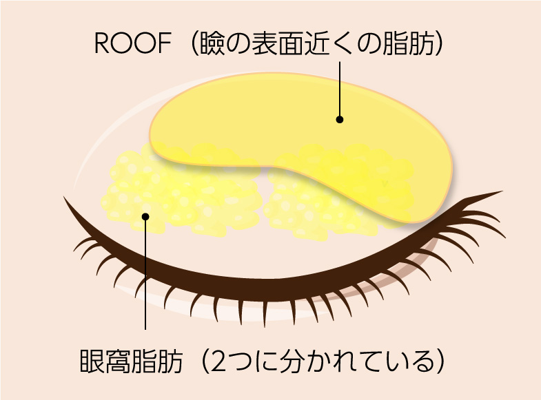 眼窩脂肪とROOFのイメージ図
