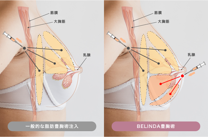 BELINDA独自の脂肪豊胸注入術