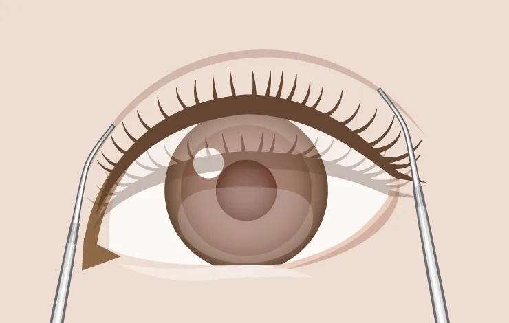 眼瞼下垂デザインイメージ