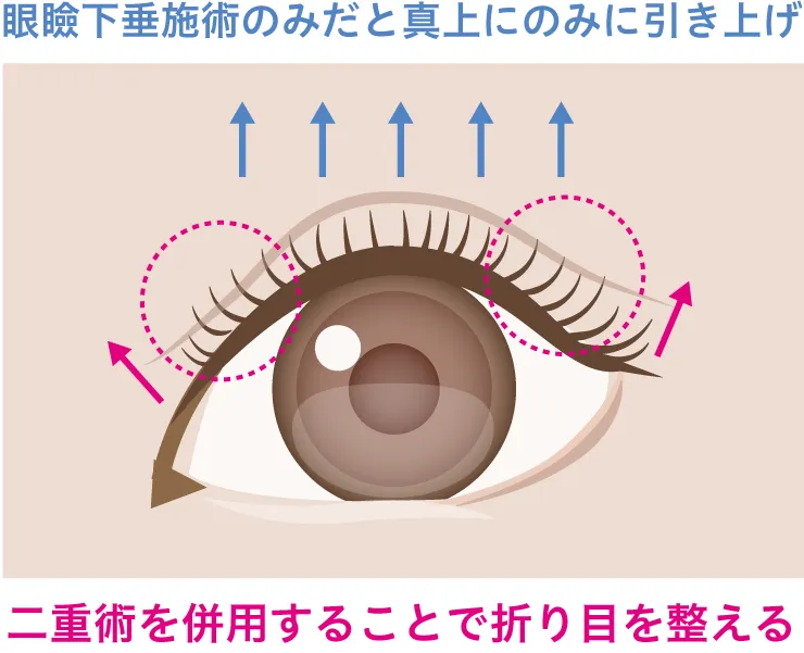 眼瞼下垂のみの二重イメージ