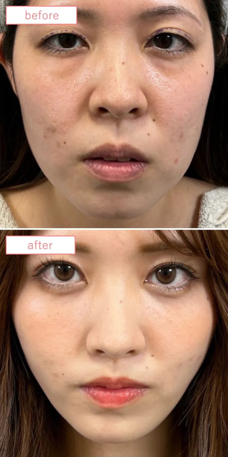 エラボトックスと顔の脂肪吸引複合施術症例