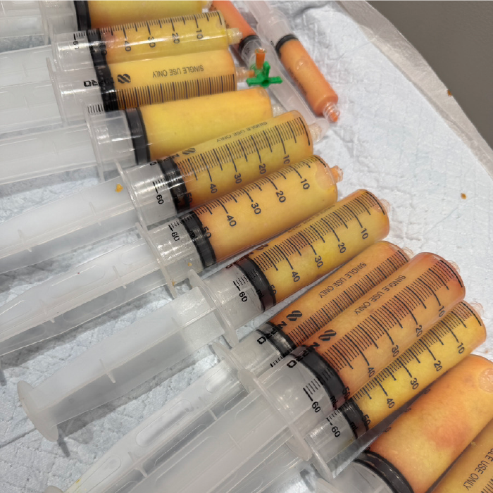 脂肪吸引量イメージ