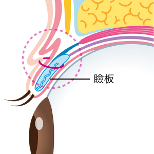 瞼板法イメージ01