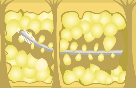 バイブロフィット脂肪吸引イメージ
