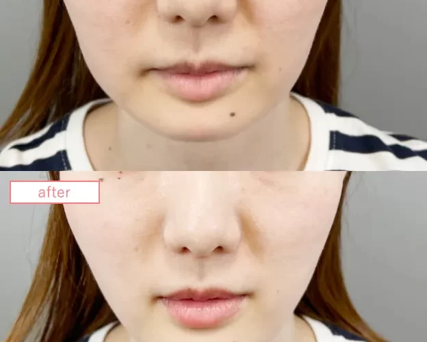 糸リフト症例No20230526-lift-s02