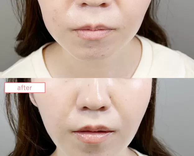 糸リフト症例No20230526-lift-s04