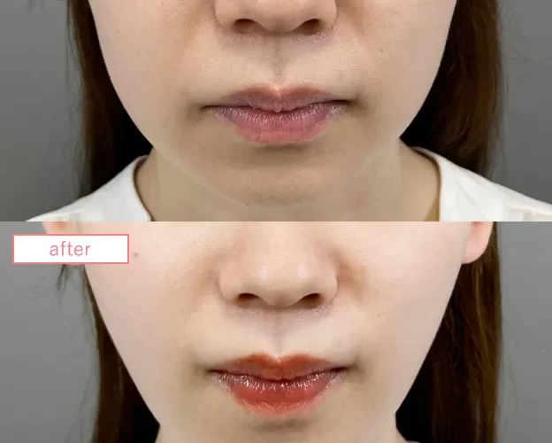 糸リフト症例No20230526-lift-s05