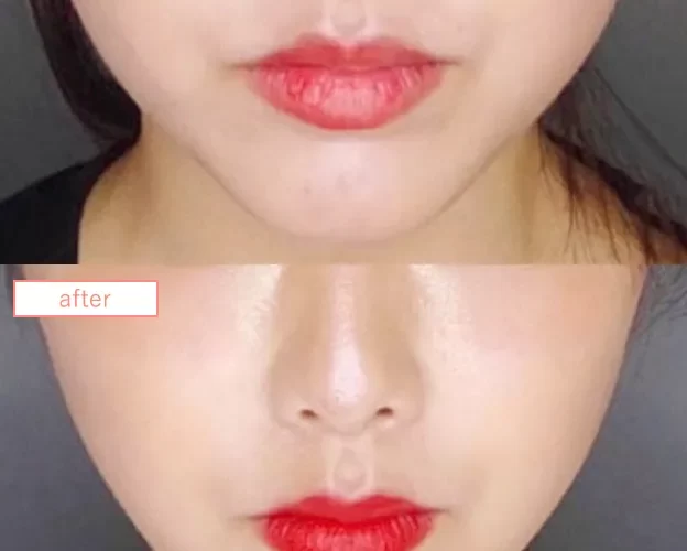 糸リフトNo7BB45ED5