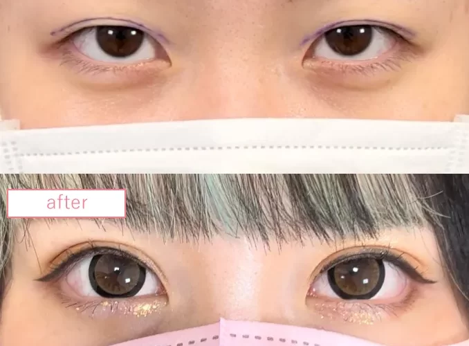 グラマラスライン症例No20230519-02