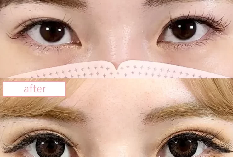 二重埋没法修正症例No20230510-01