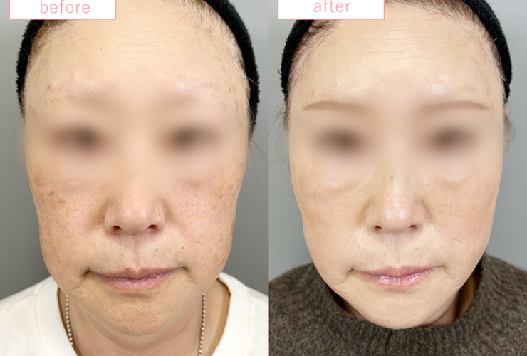 糸リフト症例No20230506-07