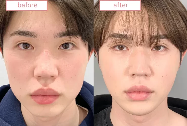 糸リフト症例No20230506-03