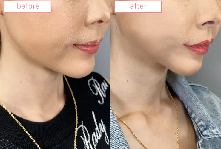 糸リフト症例No20230506-02