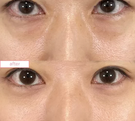 切らないクマ取り症例No.20230507_01