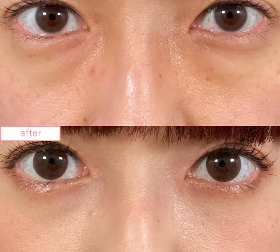 切らないクマ取り症例No.20230507_02