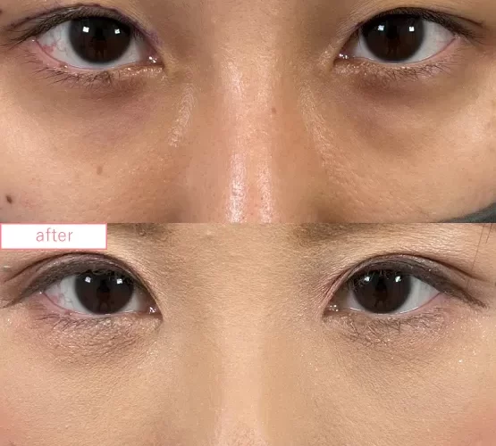 切らないクマ取り症例No.20230507_03