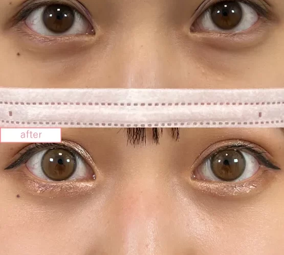 切らないクマ取り症例No.20230507_04