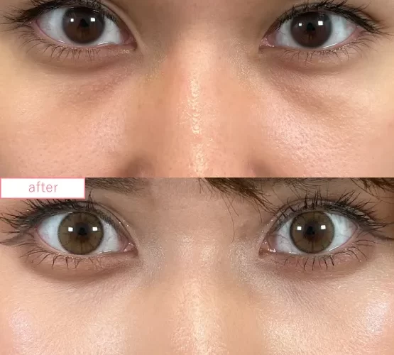 切らないクマ取り症例No.20230507_05