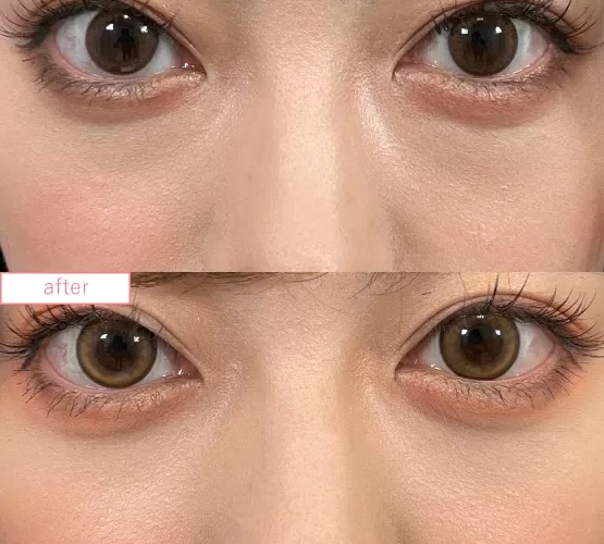 切らないクマ取り症例No.20230507_06