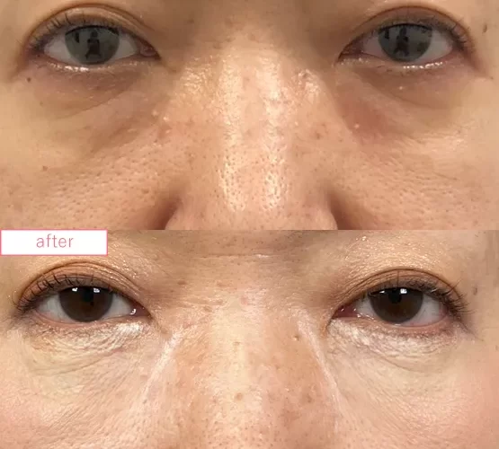 切らないクマ取り症例No.20230507_07