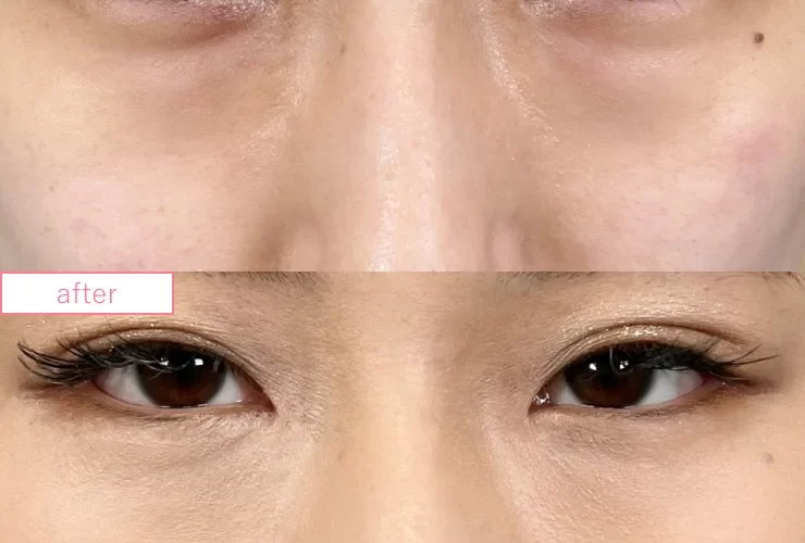 切らないクマ取り症例No.20230507_08