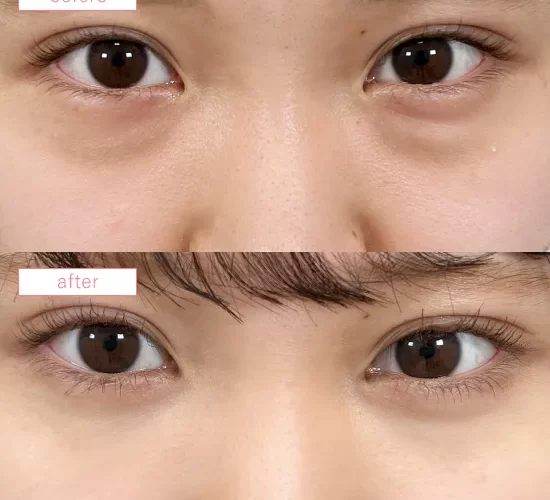 切らないクマ取り症例No.20230507_09