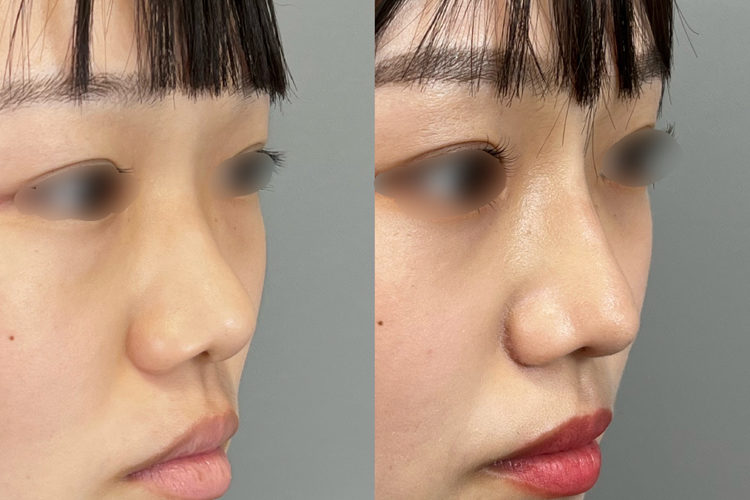 隆鼻術（メッシュ法）症例