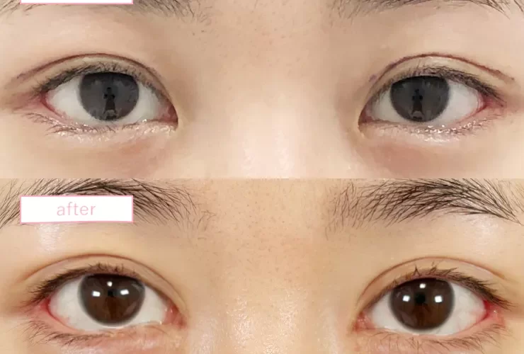 目頭切開症例No20230905