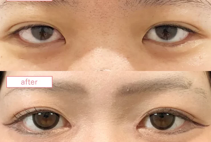 目頭切開症例No20230905