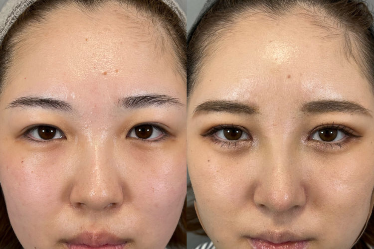 隆鼻術プロテーゼ症例No230913-1