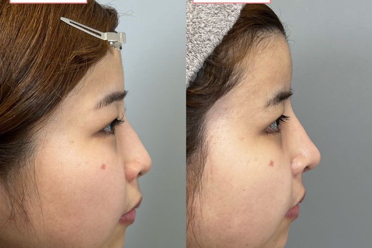 鼻中隔延長・隆鼻術プロテーゼ症例20230915-4