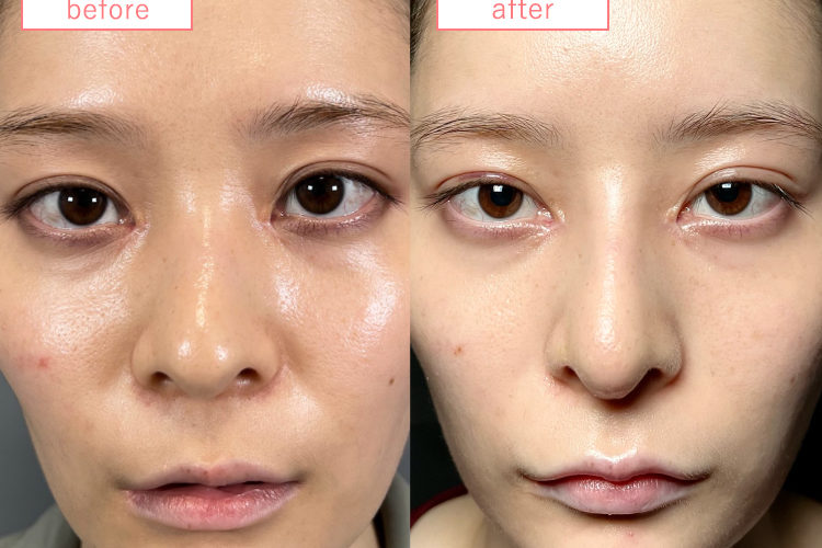 鼻中隔延長・隆鼻術プロテーゼ症例-20230915-2