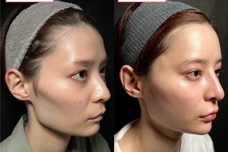 鼻中隔延長・隆鼻術プロテーゼ症例-20230915-3