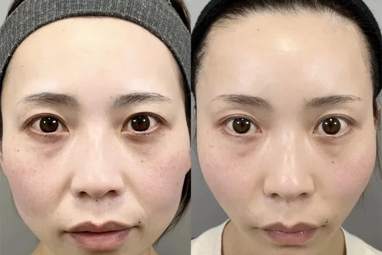 小顔脂肪吸引症例No20231010-01