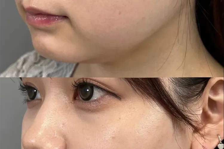 小顔脂肪吸引症例No20231010-02