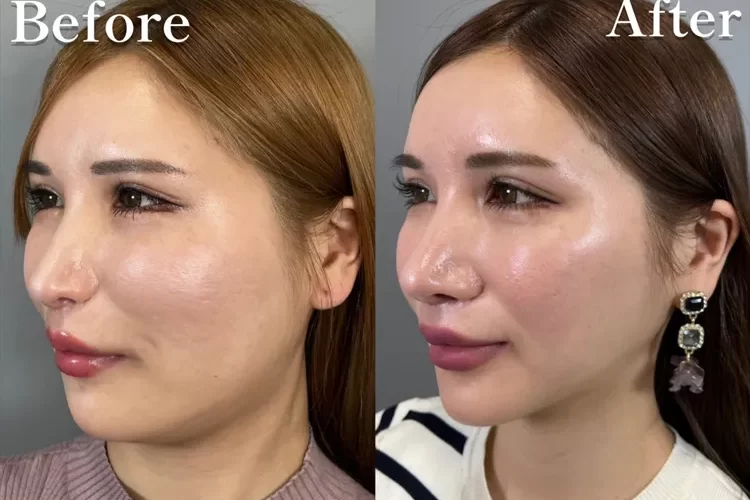 小顔脂肪吸引症例No20231010-04