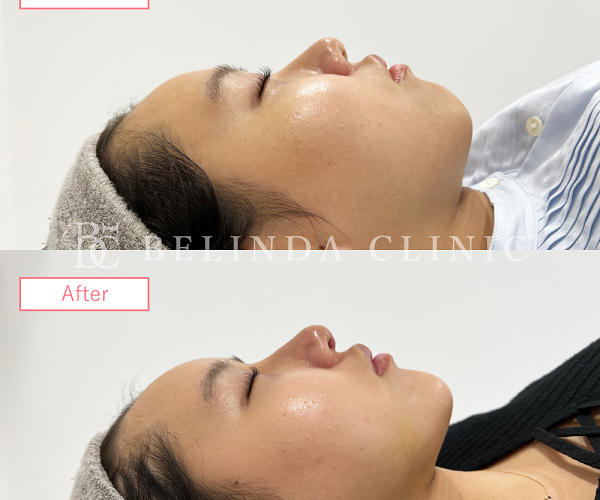 小顔脂肪吸引No3849