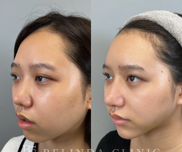 小顔脂肪吸引No3849_2