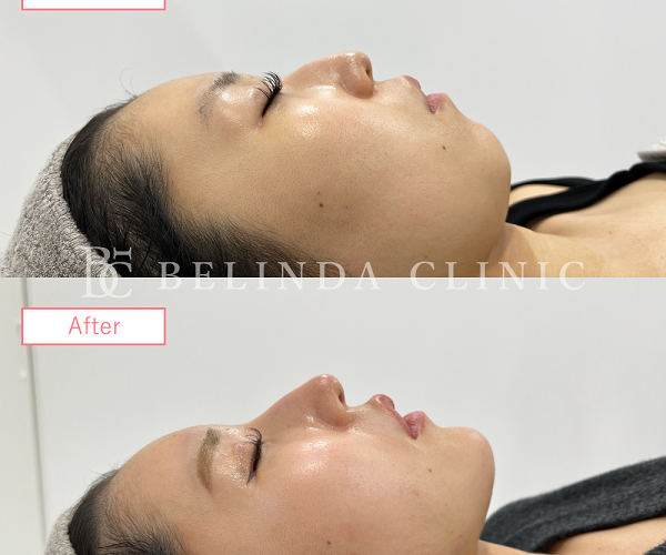 小顔脂肪吸引No3857