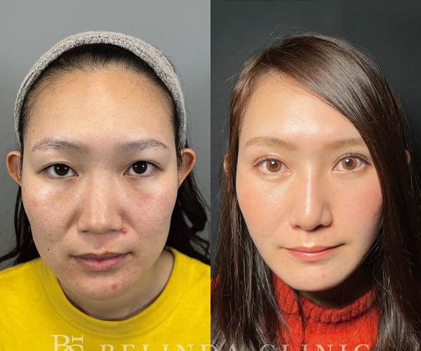 小顔脂肪吸引No4006